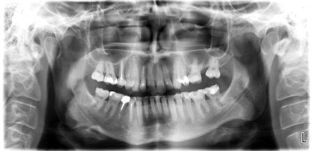 Panoramiczne zdjęcie rentgenowskie jamy ustnej z widocznymi zębami leczonymi kanałowo i wypełnieniami. Obraz wykorzystywany w diagnostyce ortodontycznej oraz planowaniu leczenia nakładkami Invisalign®.