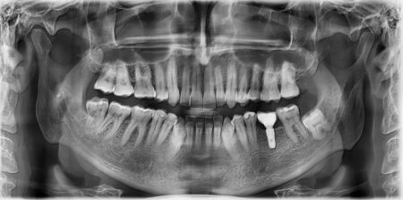 Panoramiczne zdjęcie rentgenowskie jamy ustnej z widocznym implantem zębowym w dolnej szczęce. Obraz przedstawia pełne uzębienie, kości szczęki i żuchwy, wykorzystywane w diagnostyce ortodontycznej i planowaniu leczenia nakładkami Invisalign®.