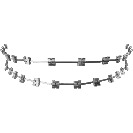 Metalowy aparat ortodontyczny stały – widok zamków i łuków na dwa łuki zębowe, stosowany w leczeniu wad zgryzu.