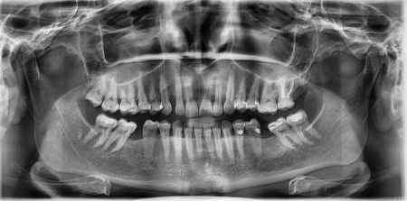 Panoramiczne zdjęcie rentgenowskie zębów – obraz RTG szczęki i żuchwy, wykorzystywany w diagnostyce ortodontycznej oraz planowaniu leczenia nakładkami Invisalign®