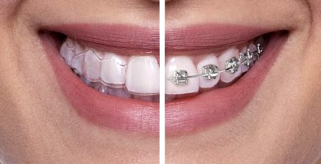 Uśmiech z nakładkami i stałym aparatem ortodontycznym