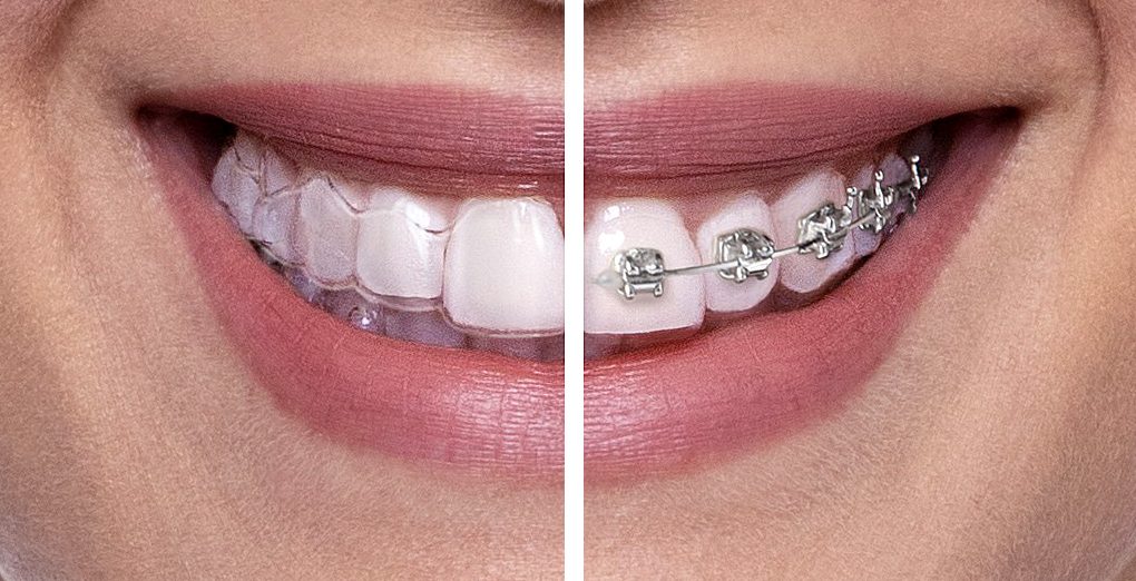 Uśmiech z nakładkami i stałym aparatem ortodontycznym