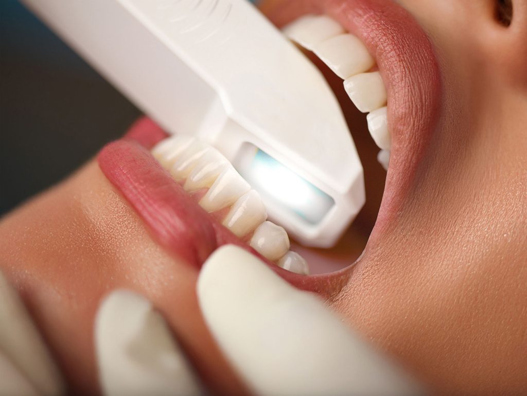 Skanowanie jamy ustnej skanerem iTero Lumina od Aglin Technology.