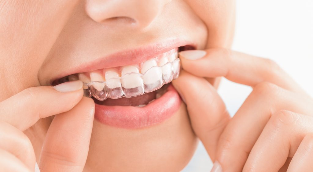 Piękny, biały uśmiech z nakładką Invisalign