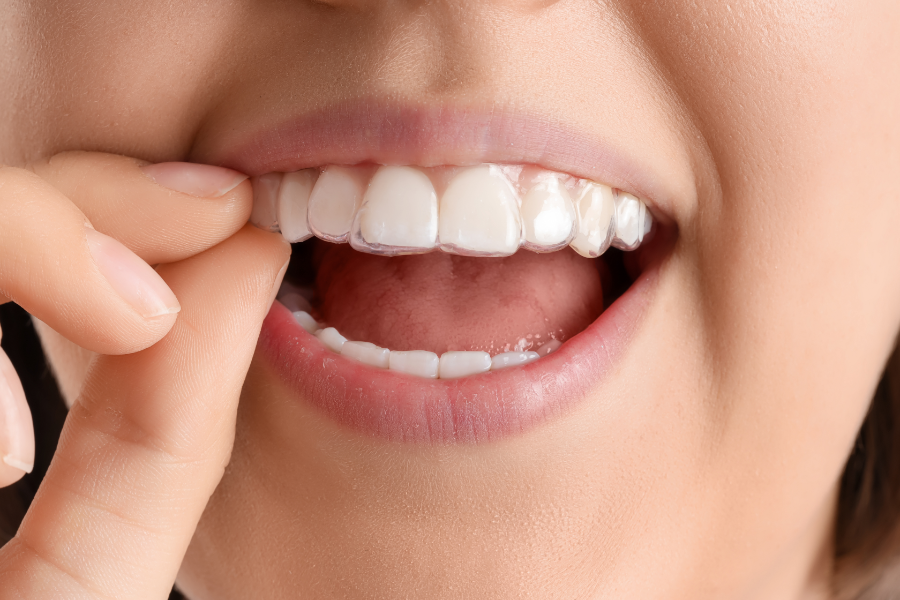 Kobieta nakłada na zęby przezroczyste nakładki Invisalign.